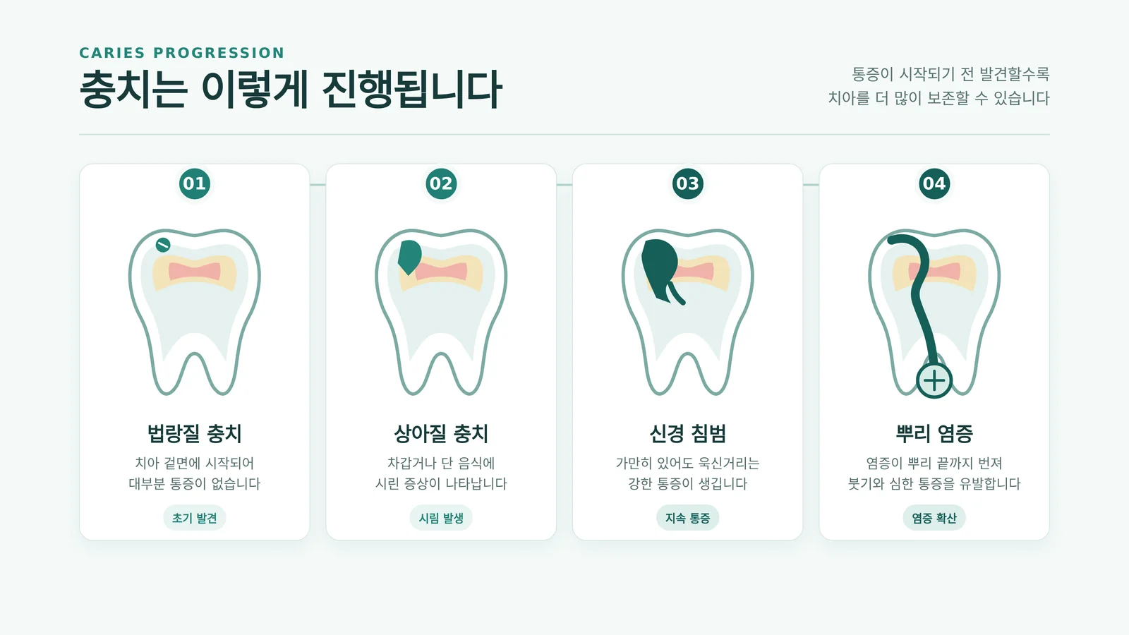 충치 진행 4단계 어금니 단면 도해